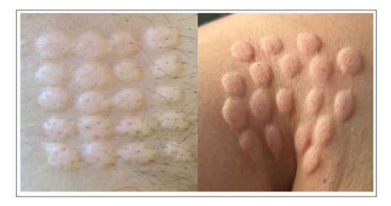 magen de autoaplicacion Epicutánea o Intradérmica de Exosomas Derivados de Células Dendríticas. Superficial, No invasiva,.